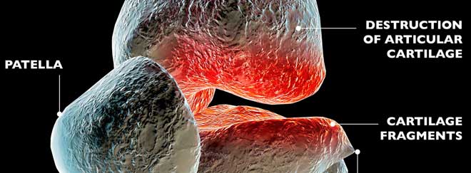 Artrosis de rodilla tratamiento natural