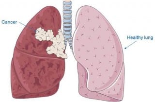 Resultado de imagen de cancer de pulmón
