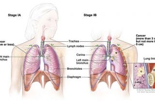 cáncer de pulmón - pronóstico en 3 marcadores