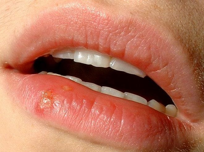 El herpes labial podría explicarse por una mutación genética