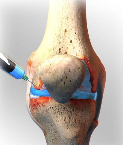 Steroids for knee pain