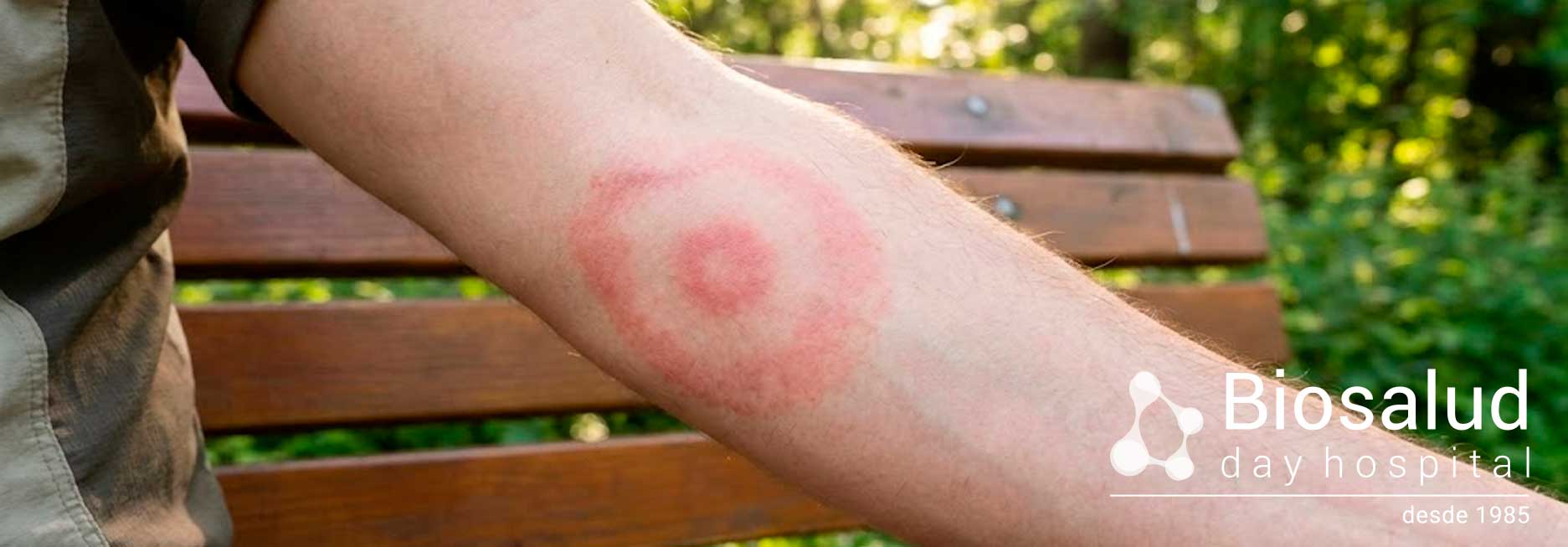 Datos sobre el contagio y prevención del Lyme que no sabías