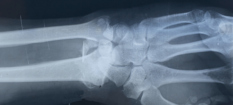 Radiografia ossea