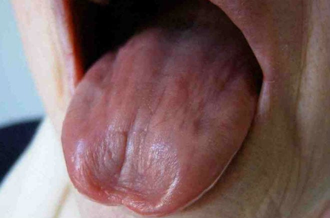 Síndrome de Sjögren en la lengua
