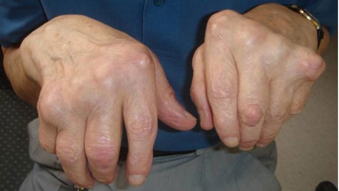 Nuevo Medicamento Biológico Para La Artritis Reumatoide