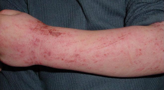 Medicina Biologica Biosalud Pruebas para diagnosticar la alergia en la piel 15