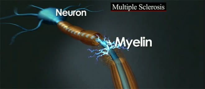 Medicina Biologica Biosalud esclerosis multiple curacion mielina 6