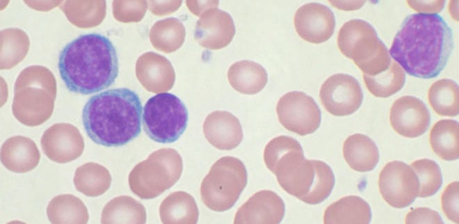 La Leucemia Podría Tratarse Eficazmente Con Una Terapia Genética