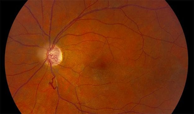 Medicina Biologica Biosalud bechet lesiones oculares 624x368 1