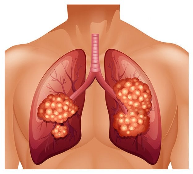 Cáncer de pulmón y mutaciones gen KRAS