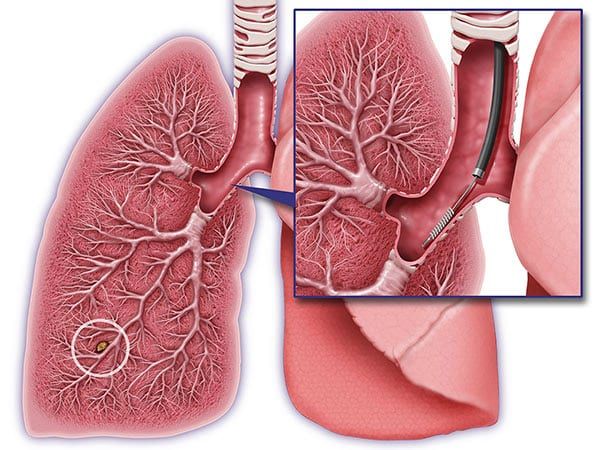 Medicina Biologica Biosalud cancer pulmon clasificador genetico