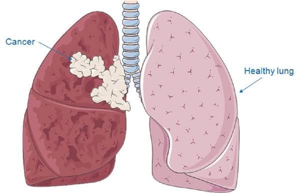 Medicina Biologica Biosalud cancer pulmon