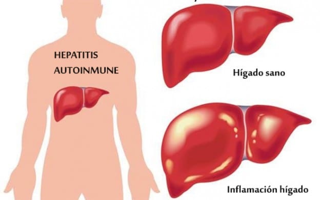 Hepatitis autoinmune, cuando el propio cuerpo ataca al hígado