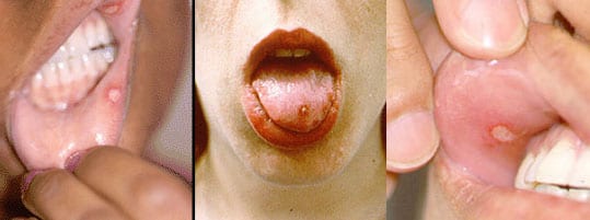 Behcet ulceras orales